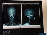 Deux radiographies d'un crâne s'affichent sur un écran d'ordinateur