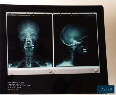 Deux radiographies d'un crâne s'affichent sur un écran d'ordinateur