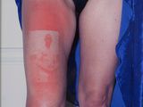 a woman that has a red spot on her knee