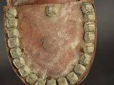 a close up of a tooth with a missing tooth