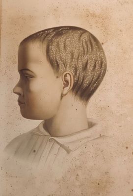 CAZENAVE (Alphée)Traité des Maladies du Cuir Chevelu, suivi …