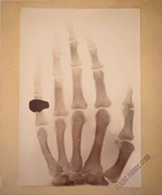 an old photo of a hand with a broken bone