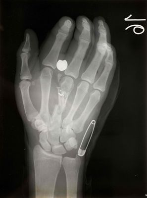 an x - ray image of a hand with an apple logo on it